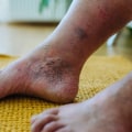 The Impact of Diabetes on the Feet: Understanding Diabetic Foot Problems