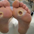 Expert Tips for Caring for Diabetic Feet