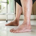 The Importance of Early Detection and Treatment for Diabetic Foot Problems