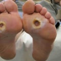 Managing Diabetic Foot Pain: Expert Tips for Relief