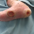 The Impact of Diabetes on Foot Health