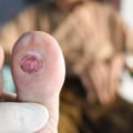 Preventing and Treating Stage 4 Diabetic Foot Ulcers