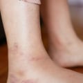 The Importance of Early Detection and Management of Diabetes in Your Feet