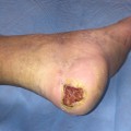The Devastating Effects of Stage 5 Diabetic Foot