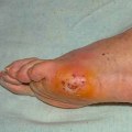 Expert Insights: Managing Foot Problems in Diabetes