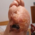 The Importance of Early Detection and Treatment of Diabetic Foot Ulcers