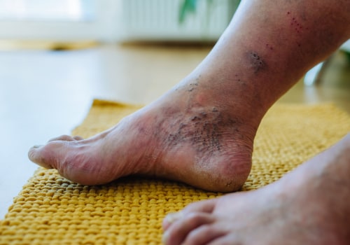 The Impact of Diabetes on the Feet: Understanding Diabetic Foot Problems