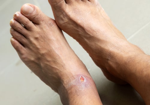 The Devastating Effects of Diabetic Foot Ulcers: Understanding the 5 Stages of this Common Complication