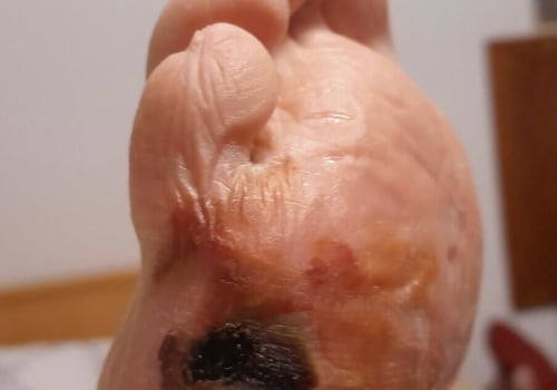Preventing Diabetic Foot Ulcers: A Podiatrist's Perspective