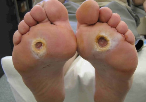 Expert Tips for Caring for Diabetic Feet