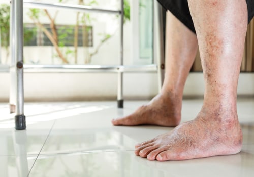 The Importance of Early Detection and Treatment for Diabetic Foot Problems