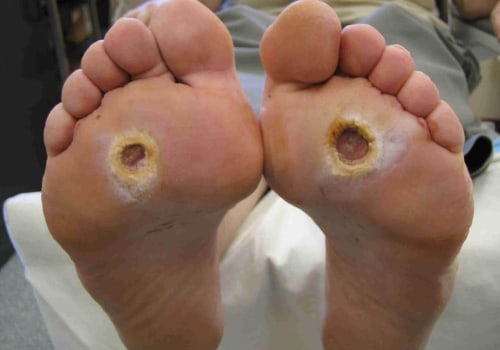 Managing Diabetic Foot Pain: Expert Tips for Relief