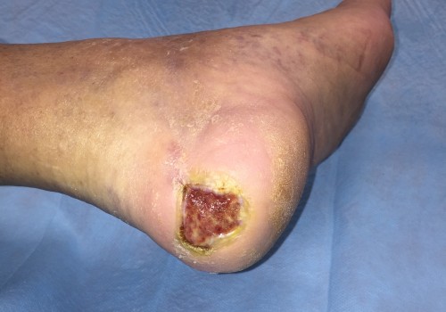 Preventing and Managing Diabetic Foot Ulcers