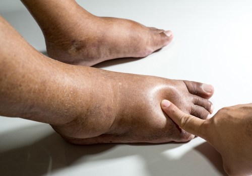 Expert Tips for Diabetic Foot Care: Protecting Your Feet and Overall Health