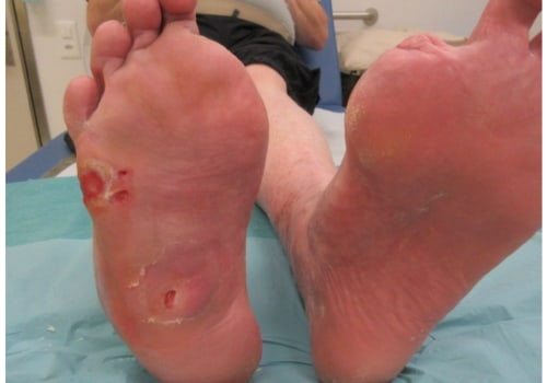 Expert Insights: Understanding and Managing Diabetic Foot