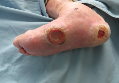 The Impact of Diabetes on Foot Health