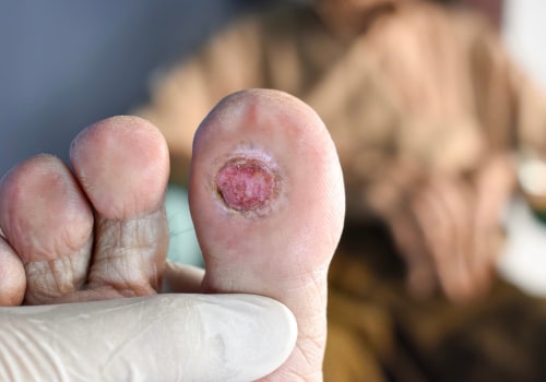 Preventing and Treating Stage 4 Diabetic Foot Ulcers