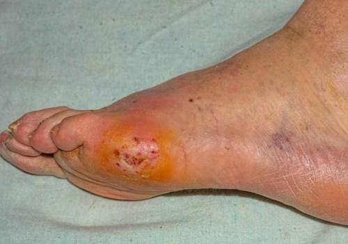 Expert Insights: Managing Foot Problems in Diabetes